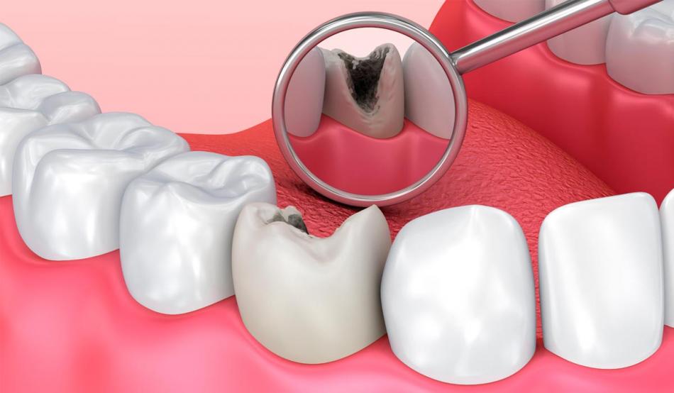 Возникновение кариеса - причины появления плохих зубов.