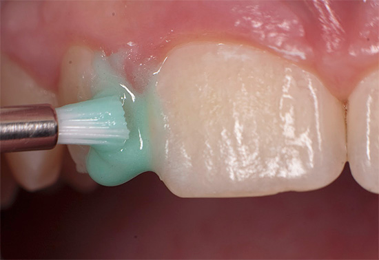 Фторирование эмали зубов в Уфе